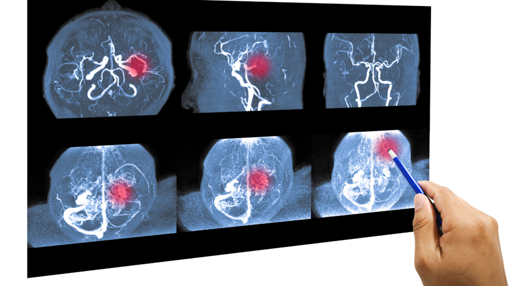 Aneurisma cerebral